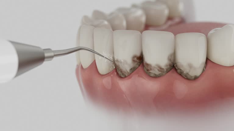 Trusted Dental Crowns And Bridges service in San Carlos, CA - Dentist Open Now